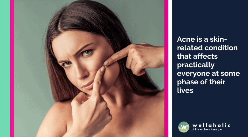 Acne is a skin-related condition that affects practically everyone at some phase of their lives