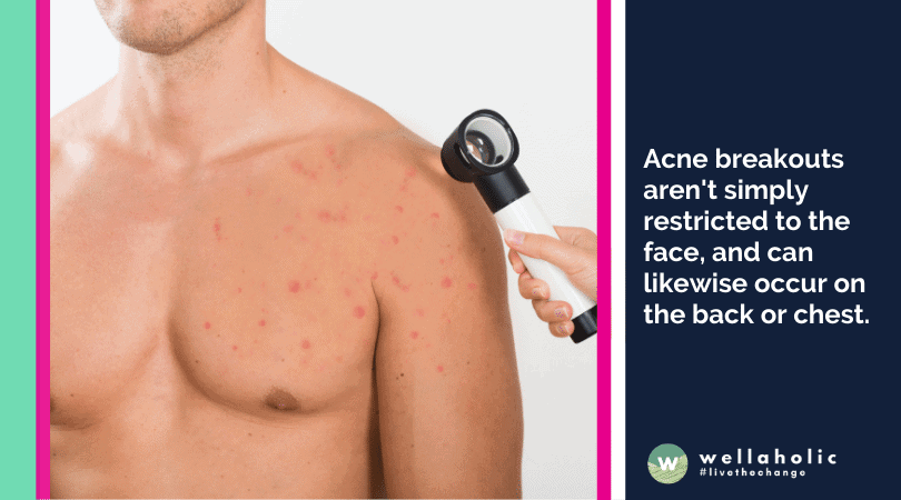 Examine the different factors causing acne