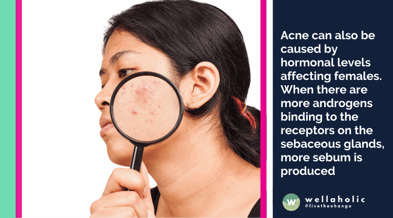 Is your hormonal level causing acne