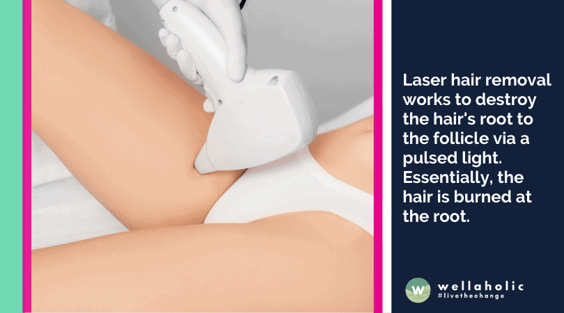 Why is Brazilian laser hair removal much better than waxing
