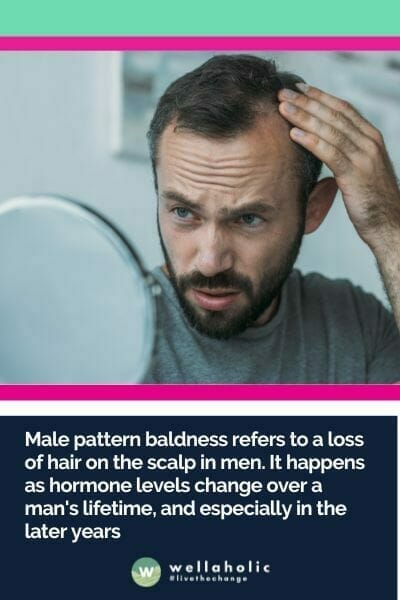 男性型脱发指的是男性头皮上逐渐脱发的情况，通常与男性一生中的激素变化有关，尤其是在晚年。据估计，仅在美国就有5000万男性受到这种常见状况的影响，其中一半的男性在50岁时经历了脱发。