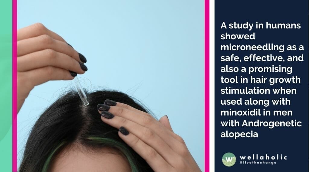 A study by Dhurat et al.[3] in humans showed microneedling as a safe, effective, and also a promising tool in hair growth stimulation when used along with minoxidil in men with Androgenetic alopecia