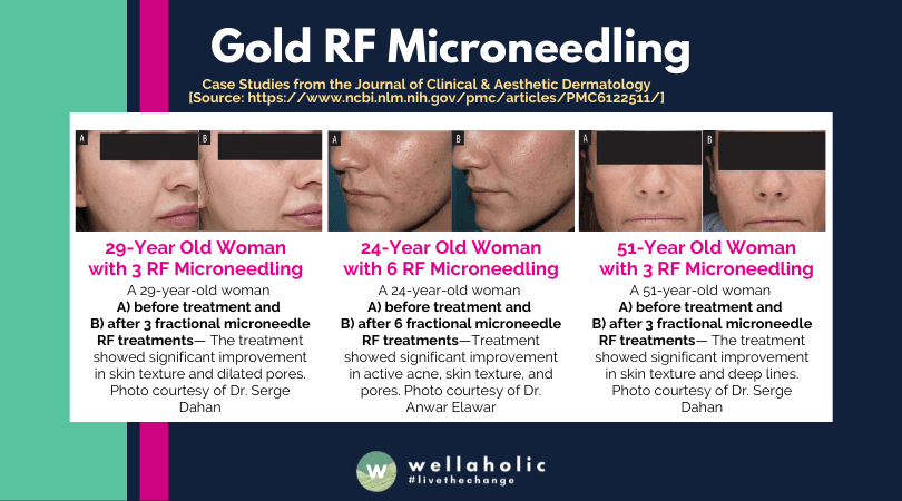 Science of Gold RF Microneedling offered by Wellaholic 