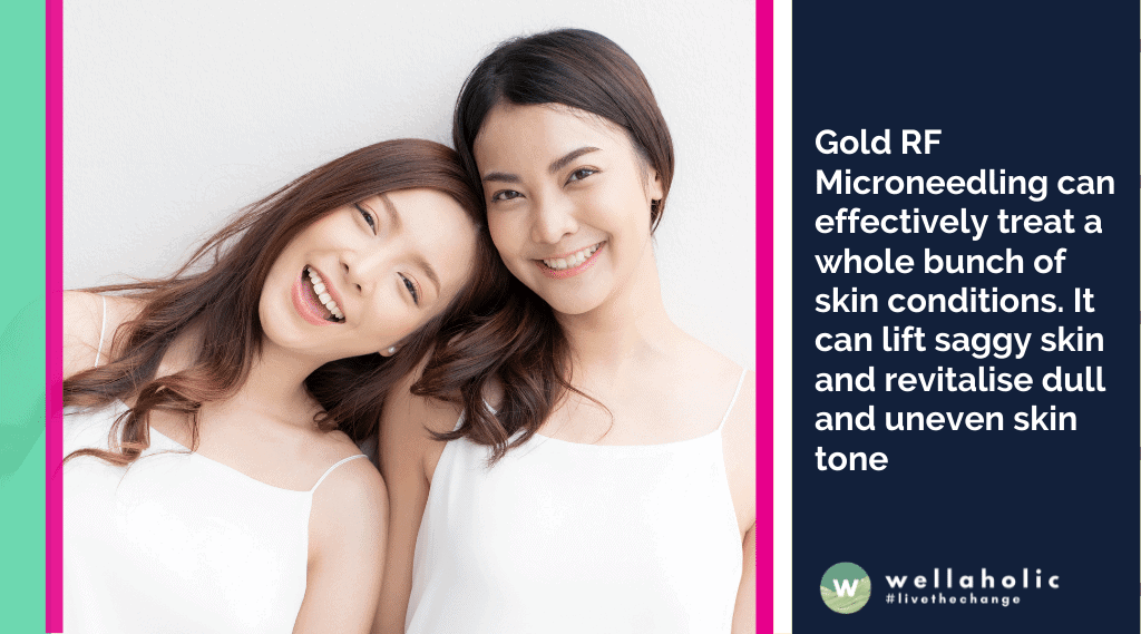 黄金RF射频微针美容可以有效地治疗许多皮肤问题。它可以提升松弛的皮肤，并使暗沉不均匀的肤色焕发活力。