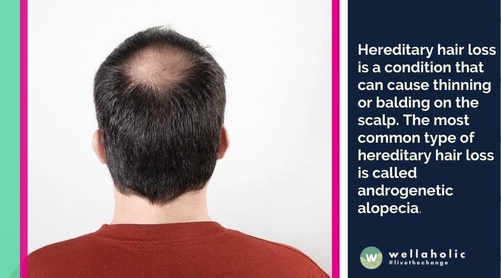Hereditary hair loss is a condition that can cause thinning or balding on the scalp. The most common type of hereditary hair loss is called androgenetic alopecia