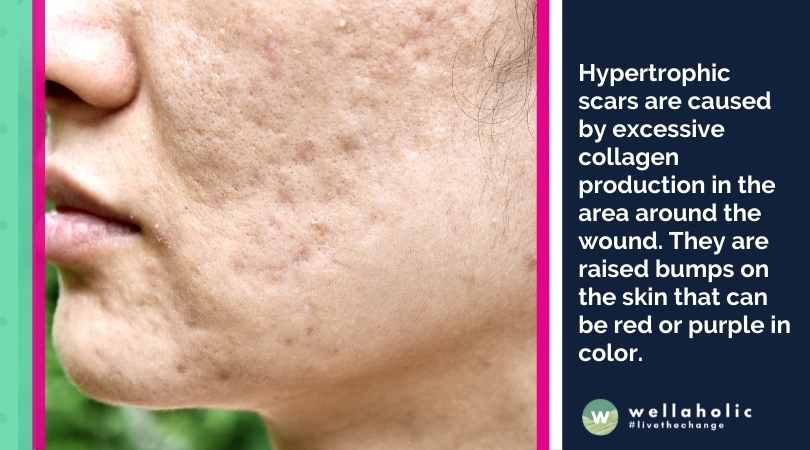 Hypertrophic scars are caused by excessive collagen production in the area around the wound. They are raised bumps on the skin that can be red or purple in color.