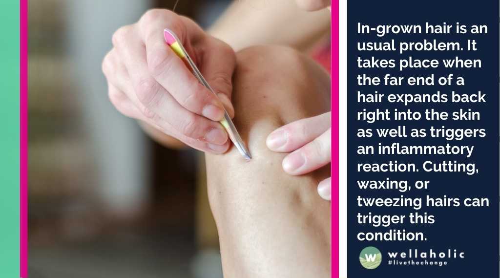 In-grown hair is an usual problem. It takes place when the far end of a hair expands back right into the skin as well as triggers an inflammatory reaction. Cutting, waxing, or tweezing hairs can trigger this condition.