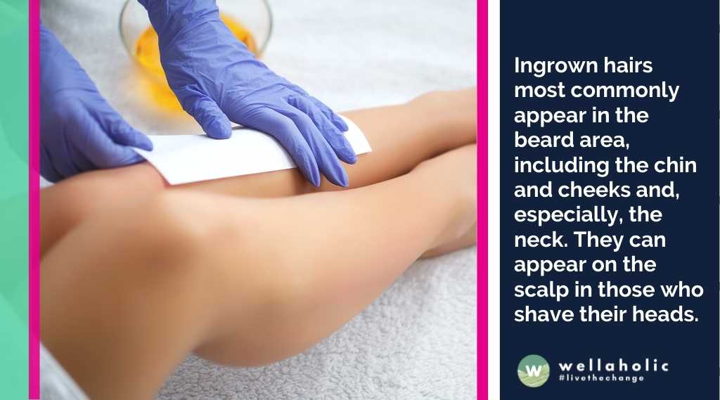 Ingrown hairs most commonly appear in the beard area, including the chin and cheeks and, especially, the neck. They can appear on the scalp in those who shave their heads.