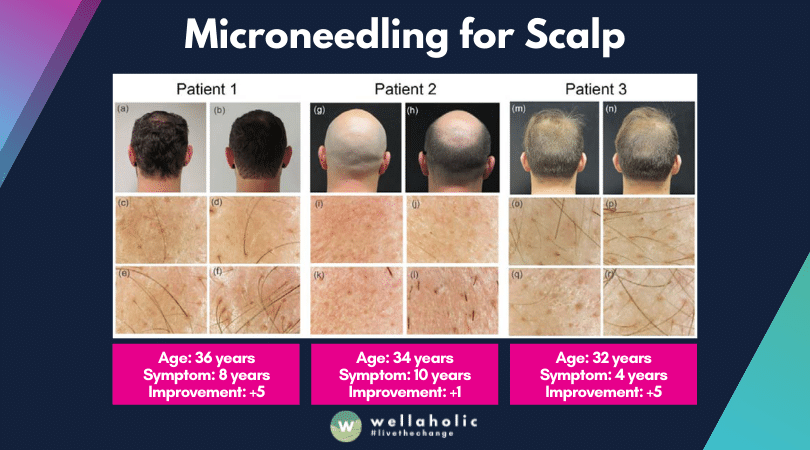 Microneedling for Scalp