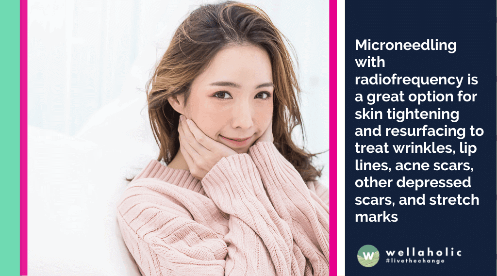 Microneedling with radiofrequency is a great option for skin tightening and resurfacing to treat wrinkles, lip lines, acne scars, other depressed scars, and stretch marks