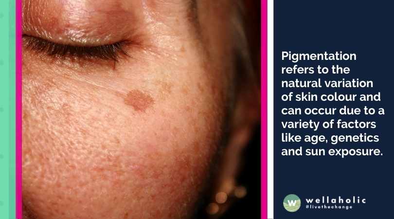 Pigmentation refers to the natural variation of skin colour and can occur due to a variety of factors like age, genetics and sun exposure.
