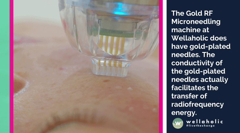 The Gold RF Microneedling machine at Wellaholic does have gold-plated needles. The conductivity of the gold-plated needles actually facilitates the transfer of radiofrequency energy. 