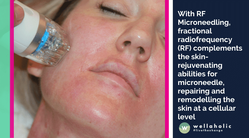 with RF Microneedling, fractional radiofrequency (RF) complements the skin-rejuvenating abilities for microneedle, repairing and remodelling the skin at a cellular level