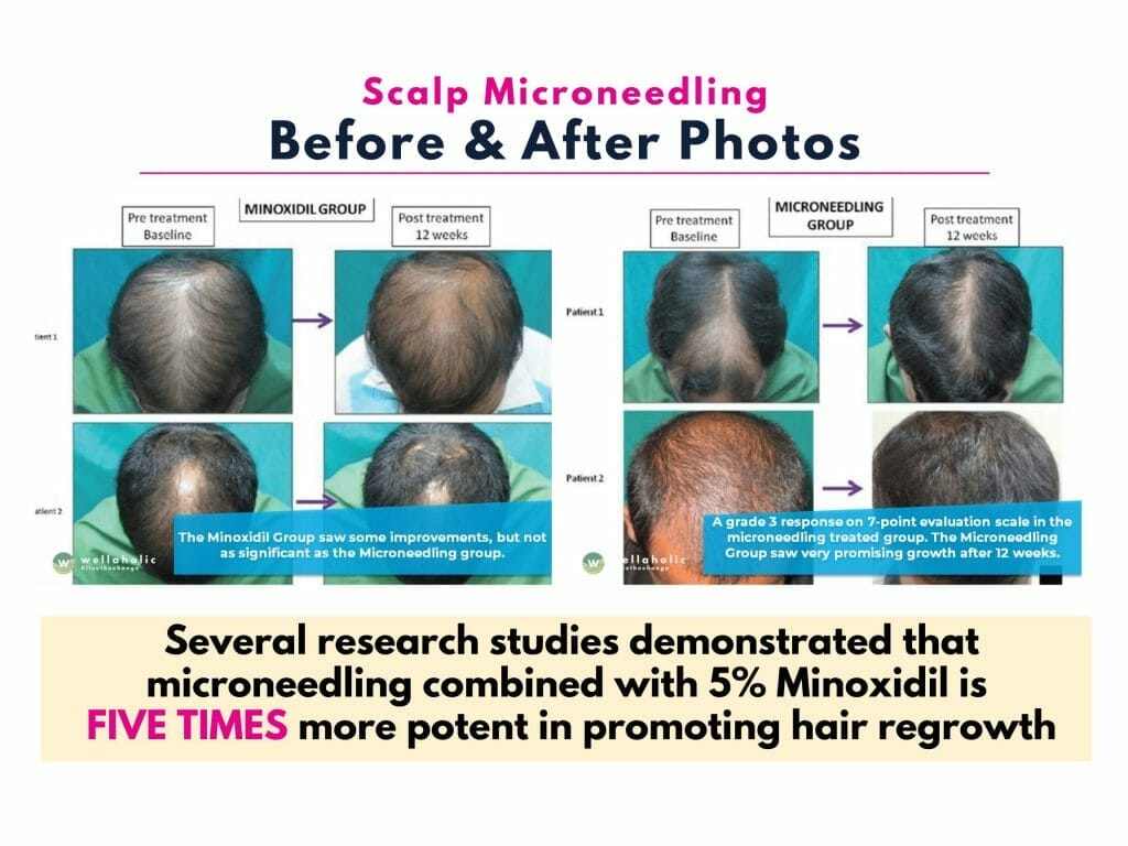 Several research studies demonstrated that microneedling combined with 5% Minoxidil is 
FIVE TIMES more potent in promoting hair regrowth