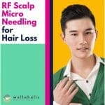 RF Scalp Micro Needling for Hair Loss