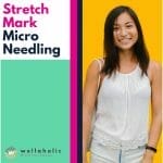 Stretch Mark Microneedling