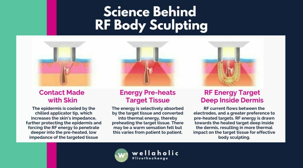 Science Behind RF Body Sculpting 射频身体塑形的科学原理