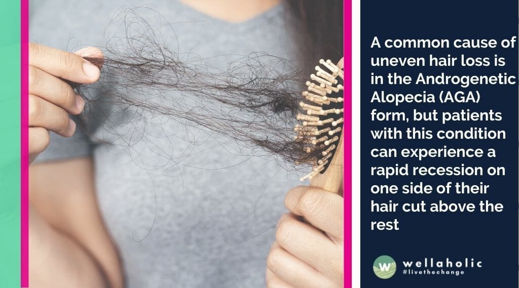 不均匀脱发的常见原因之一是雄激素性脱发（AGA），但患有这种病症的患者可能会出现头发的一侧快速消退，高于其他部位的情况。