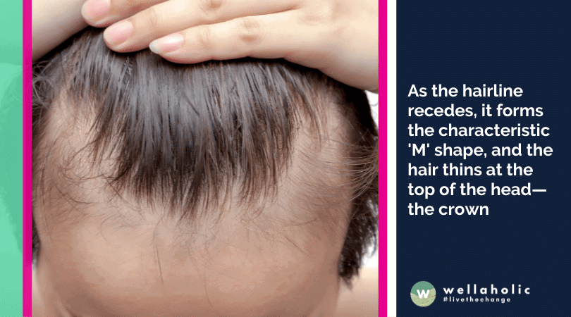 As the hairline recedes, it forms the characteristic 'M' shape, and the hair thins at the top of the head—the crown