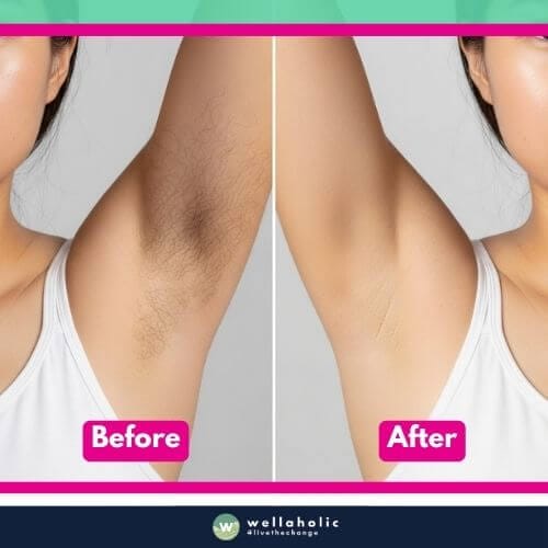 Before and after underarm hair removal results at Wellaholic, showing smoother underarms and effective hair reduction
