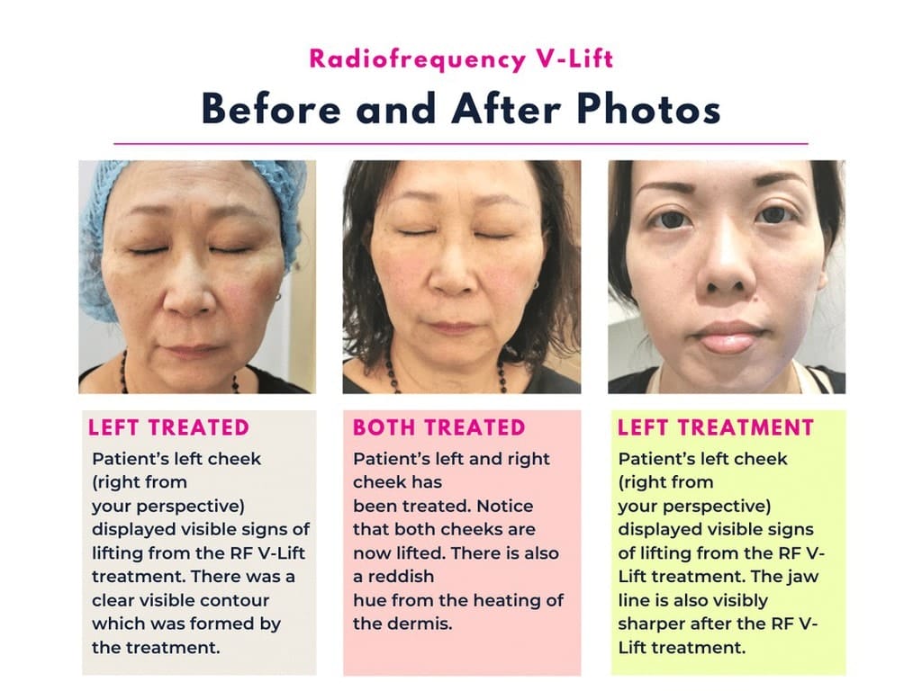 Before and After RF Vlift