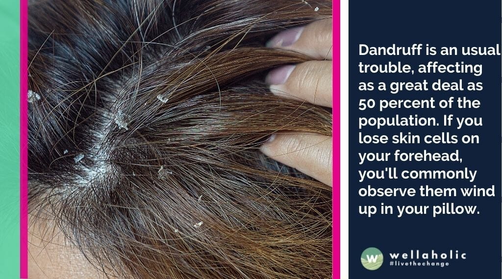 头皮屑是一个常见的问题，影响了多达50%的人口。如果你在额头上掉落皮屑，你通常会注意到它们会落在枕头上。