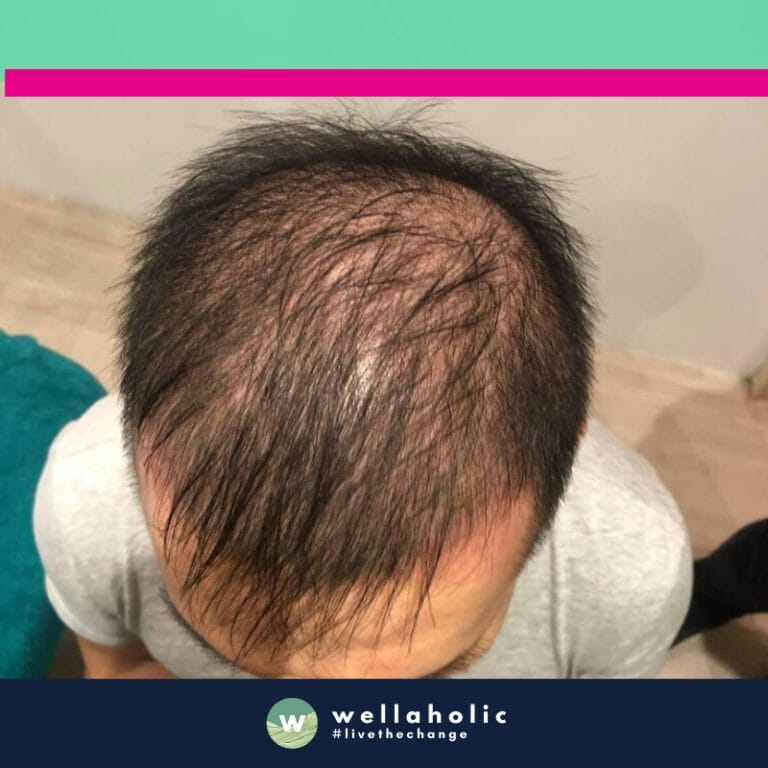 Meet our first customer, a gentleman who embarked on his hair regrowth journey with Wellaholic in March. Over the course of eight months, he experienced a transformation that was nothing short of remarkable.

In the before photos taken in March, you can clearly see the areas of thinning and hair loss. However, as the months passed and he continued with his treatments, the change became evident. The after photos taken in November show a significant increase in hair density and coverage.

This customer’s journey is a testament to the effectiveness of Wellaholic’s hair regrowth treatments. His commitment to the treatment plan and our expertise combined to create a success story that speaks volumes about the potential of our hair regrowth treatments. His transformation is not just about regaining lost hair, but also about restoring confidence and self-esteem. Stay tuned as we share more such inspiring transformations in the upcoming sections.