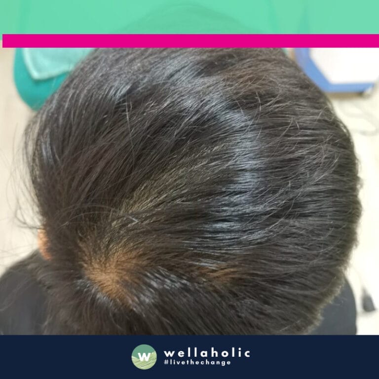 Meet our first customer, a gentleman who embarked on his hair regrowth journey with Wellaholic in March. Over the course of eight months, he experienced a transformation that was nothing short of remarkable.

In the before photos taken in March, you can clearly see the areas of thinning and hair loss. However, as the months passed and he continued with his treatments, the change became evident. The after photos taken in November show a significant increase in hair density and coverage.

This customer’s journey is a testament to the effectiveness of Wellaholic’s hair regrowth treatments. His commitment to the treatment plan and our expertise combined to create a success story that speaks volumes about the potential of our hair regrowth treatments. His transformation is not just about regaining lost hair, but also about restoring confidence and self-esteem. Stay tuned as we share more such inspiring transformations in the upcoming sections.