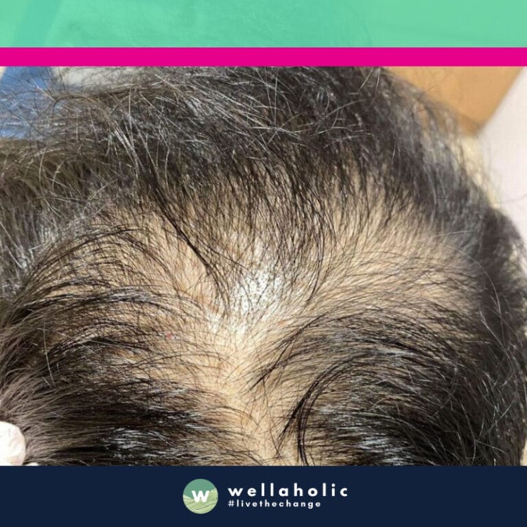 Introducing our second customer, a gentleman who was concerned about his thinning hair. He began his journey with Wellaholic in March and completed his treatment in November. His commitment to addressing his hair loss led him to undertake our disciplined HairGrow combo treatment, with weekly sessions.

The before photos from March clearly show the areas of thinning hair that were of concern to him. However, as he diligently attended his weekly sessions, the transformation began to unfold. The after photos from November reveal a significant improvement in hair density, a testament to the effectiveness of our HairGrow combo treatment.

This customer’s journey is a powerful example of how discipline, combined with Wellaholic’s expertise and effective treatments, can lead to remarkable results. His story is not just about hair regrowth, but also about the restoration of confidence and self-esteem. His transformation truly embodies our motto - “See the results to believe!” Stay tuned for more inspiring transformations in the upcoming sections.