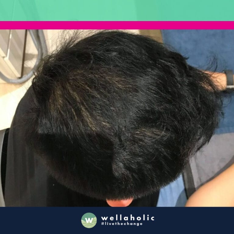 Introducing our second customer, a gentleman who was concerned about his thinning hair. He began his journey with Wellaholic in March and completed his treatment in November. His commitment to addressing his hair loss led him to undertake our disciplined HairGrow combo treatment, with weekly sessions.

The before photos from March clearly show the areas of thinning hair that were of concern to him. However, as he diligently attended his weekly sessions, the transformation began to unfold. The after photos from November reveal a significant improvement in hair density, a testament to the effectiveness of our HairGrow combo treatment.

This customer’s journey is a powerful example of how discipline, combined with Wellaholic’s expertise and effective treatments, can lead to remarkable results. His story is not just about hair regrowth, but also about the restoration of confidence and self-esteem. His transformation truly embodies our motto - “See the results to believe!” Stay tuned for more inspiring transformations in the upcoming sections.