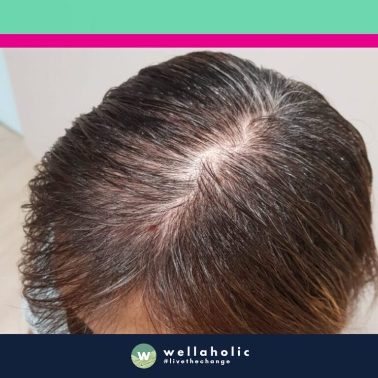 Our third customer is a woman who was concerned about her thinning hair. She embarked on her hair regrowth journey with Wellaholic in August. Over the course of 22 treatments, which spanned until the following March, she experienced a significant improvement in the health of her scalp and the density of her hair.

The before photos from August show the thinning hair that initially brought her to Wellaholic. However, as she continued with her treatments, the transformation became evident. The after photos from March reveal a healthier scalp and improved hair density.

This customer’s journey is a testament to the effectiveness of Wellaholic’s hair regrowth treatments. Her commitment to the treatment plan and our expertise combined to create a success story that speaks volumes about the potential of our hair regrowth treatments. Her transformation is not just about regaining lost hair, but also about restoring confidence and self-esteem. After her successful transformation, we recommended that she stop her treatments, a testament to the effectiveness of our approach.