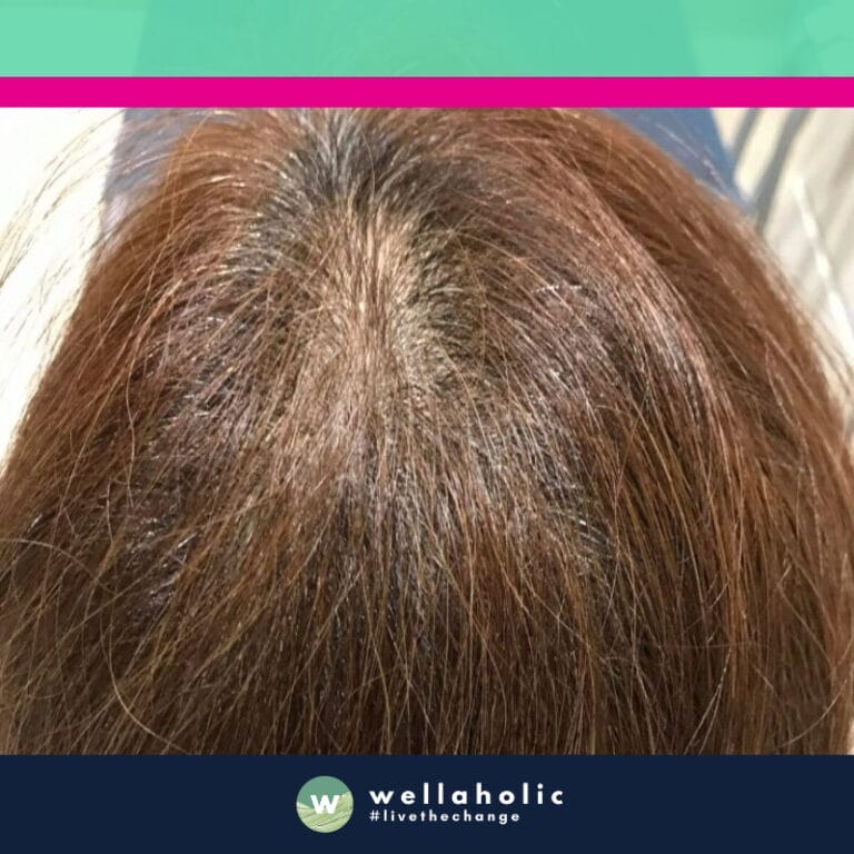 Our third customer is a woman who was concerned about her thinning hair. She embarked on her hair regrowth journey with Wellaholic in August. Over the course of 22 treatments, which spanned until the following March, she experienced a significant improvement in the health of her scalp and the density of her hair.

The before photos from August show the thinning hair that initially brought her to Wellaholic. However, as she continued with her treatments, the transformation became evident. The after photos from March reveal a healthier scalp and improved hair density.

This customer’s journey is a testament to the effectiveness of Wellaholic’s hair regrowth treatments. Her commitment to the treatment plan and our expertise combined to create a success story that speaks volumes about the potential of our hair regrowth treatments. Her transformation is not just about regaining lost hair, but also about restoring confidence and self-esteem. After her successful transformation, we recommended that she stop her treatments, a testament to the effectiveness of our approach.