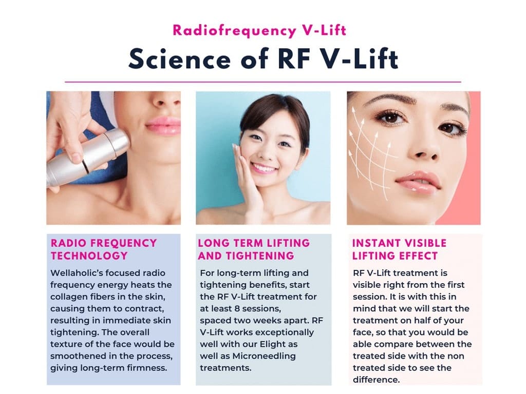 How effective is RF Vlift