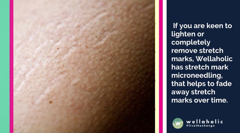  If you are keen to lighten or completely remove stretch marks, Wellaholic has a proven treatment, also known as stretch mark microneedling, that helps to fade away stretch marks over time. 