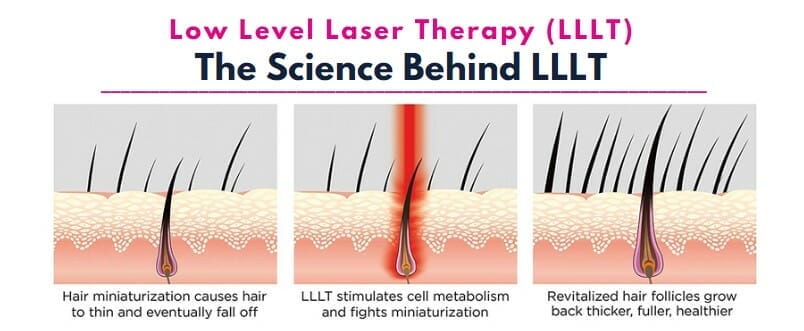 Low level laser therapy is believed to increase blood flow in the scalp and stimulate metabolism in catagen or telogen follicles, resulting in the production of anagen hair. 