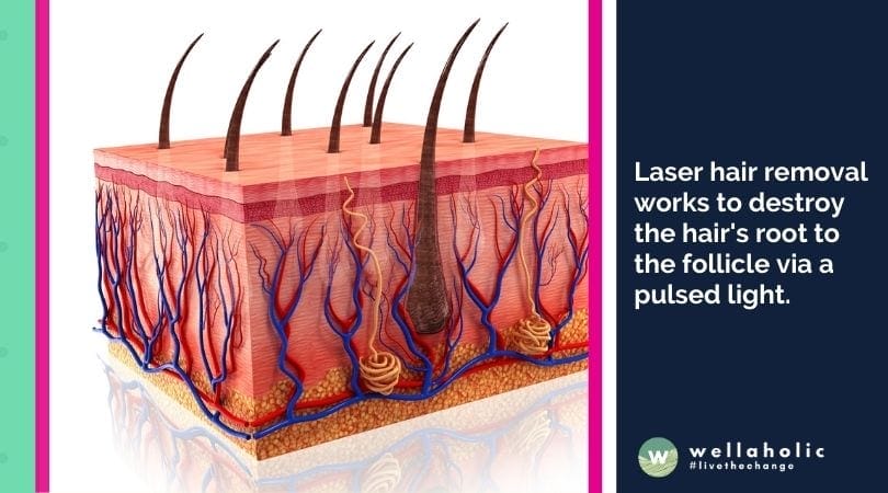 Laser hair removal works to destroy the hair's root to the follicle via a pulsed light.