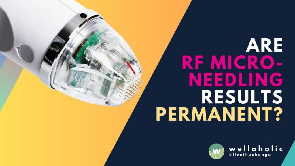 Curious about the longevity of RF microneedling results? Unveil the truth about whether they are permanent or not. Don't settle for temporary solutions - Read on to discover the facts and make an informed decision for long-lasting skin rejuvenation!