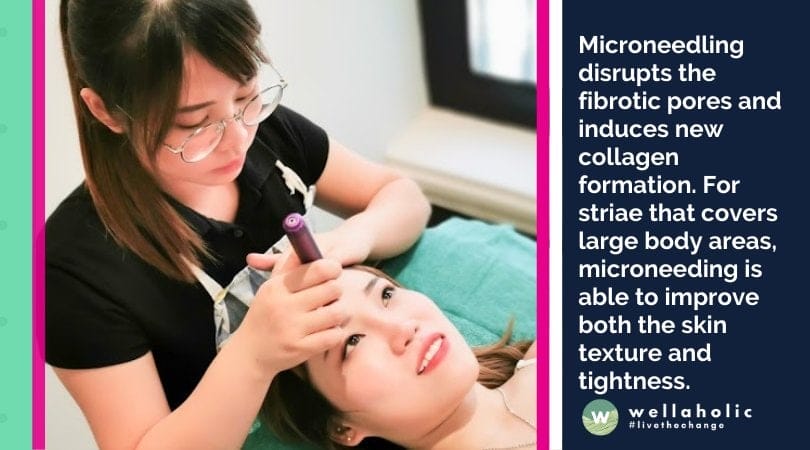 Microneedling disrupts the fibrotic pores and induces new collagen formation. For striae that covers large body areas, microneeding is able to improve both the skin texture and tightness. 