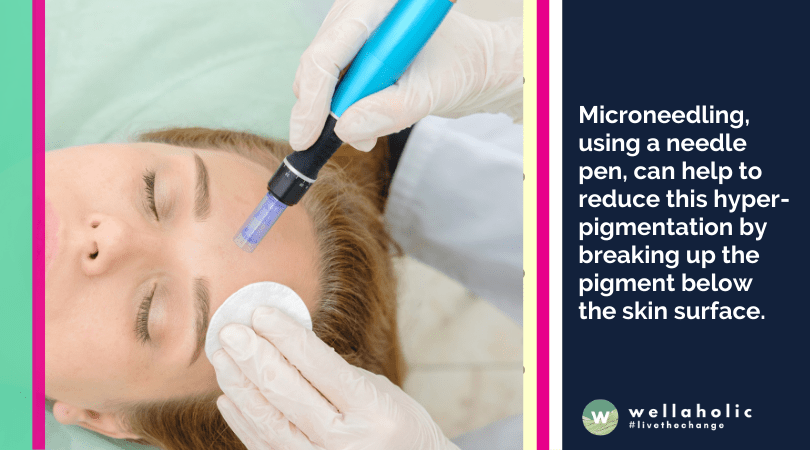 Microneedling, using a needle pen, can help to reduce this hyper-pigmentation by breaking up the pigment below the skin surface. 