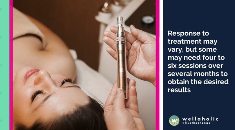 Response to treatment may vary, but some may need four to six sessions over several months to obtain the desired results