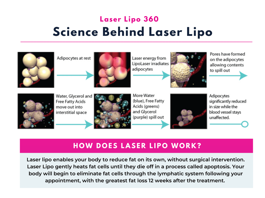 Infographic that shows the science behind laser lipo slimming treatment. Adipocytes are significantly reduced in size while the blood vessels stay unaffected during the laser lipo session. 
