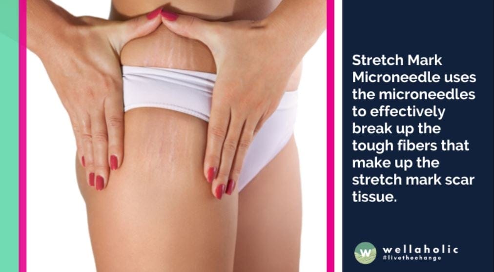 Stretch Mark Microneedle uses the microneedles to effectively break up the tough fibers that make up the stretch mark scar tissue.
