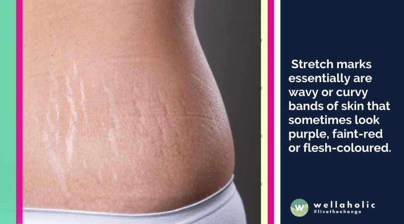  Stretch marks essentially are wavy or curvy bands of skin that sometimes look purple, faint-red or flesh-coloured.