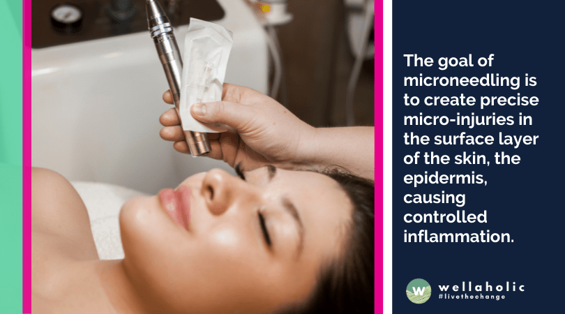 The goal of microneedling is to create precise micro-injuries in the surface layer of the skin, the epidermis, causing controlled inflammation.