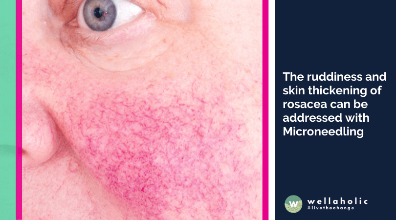 The ruddiness and skin thickening of rosacea can be addressed with Microneedling