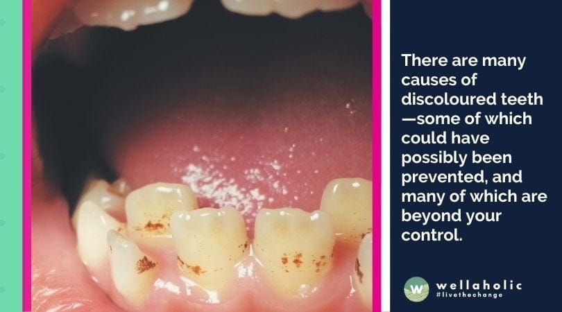 There are many causes of discoloured teeth—some of which could have possibly been prevented, and many of which are beyond your control. 