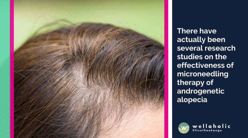 There have actually been several research studies on the effectiveness of microneedling therapy of androgenetic alopecia