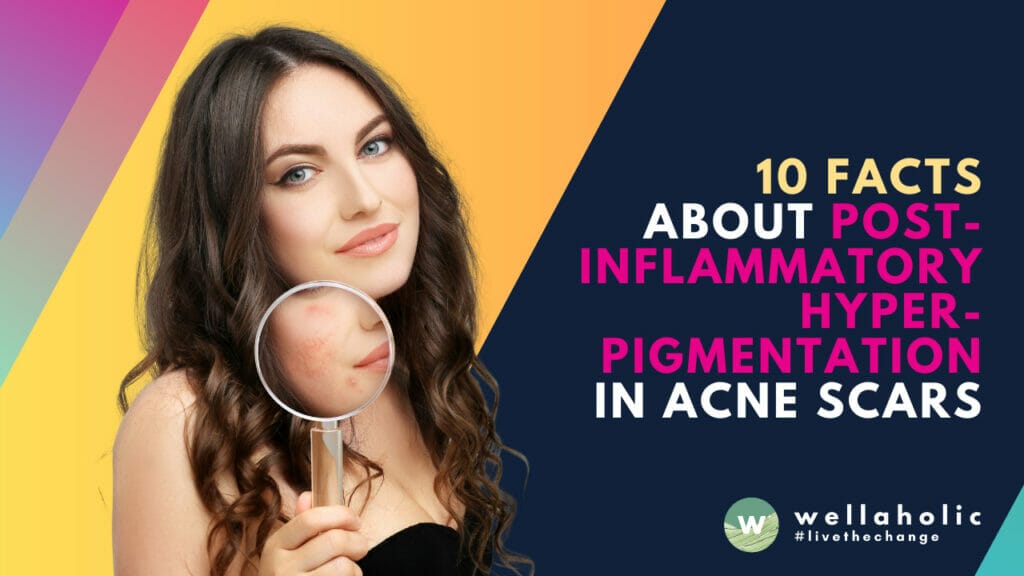 Discover the essential facts about Post-Inflammatory Hyperpigmentation in acne scars. This comprehensive guide by Wellaholic provides expert insights tailored for a Singaporean audience. Learn about causes, treatments, and prevention to achieve your best skin yet.