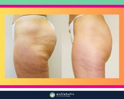 Velashape: Before and After for Thigh Cellulite