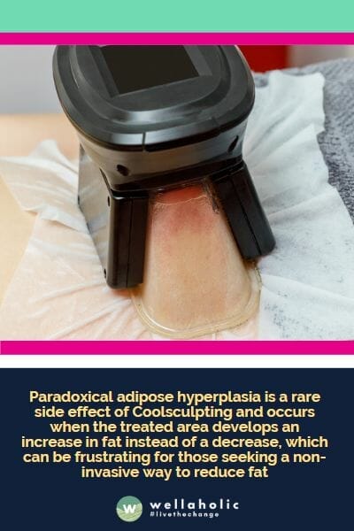 . Paradoxical adipose hyperplasia is a rare side effect of Coolsculpting and occurs when the treated area develops an increase in fat instead of a decrease, which can be frustrating for those seeking a non-invasive way to reduce fat